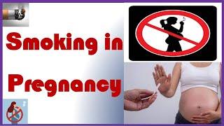 Smoking in Pregnancy  TOG Article