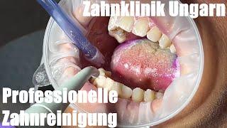 PZR Professionelle Zahnreinigung beugt Karies & Parodontitis vor Plaque Scaling Airflow Politur