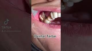 Dental Cleaning Dental Scaling #tiktok #viral #video #fyp #funny #love #dentist