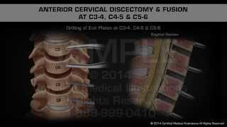 Anterior Cervical Discectomy & Fusion at C3-4 C4-5 & C5-6