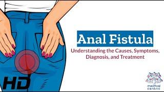 Anal Fistula Explained Causes Symptoms and Treatment