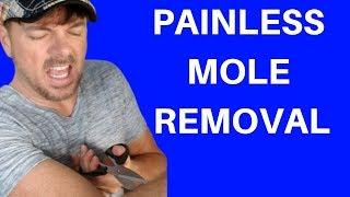 BEST WAY TO REMOVE MOLES  SKIN TAGS TOO  Chris Gibson