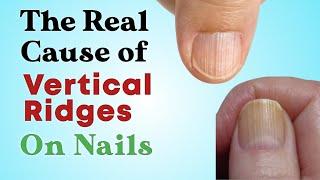 6 Causes Of Vertical Lines On Your Nails  8 Natural ways to reverse these Ridges  Nourish Nest