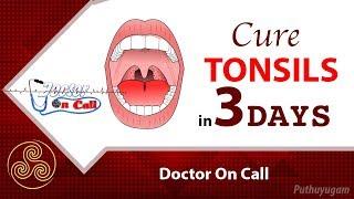 Quick Home Remedies for Tonsillitis in 3 Days  Doctor On Call