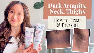 Treating and Preventing Dark Armpits Thighs Neck and Arms  Dr. Jenny Liu