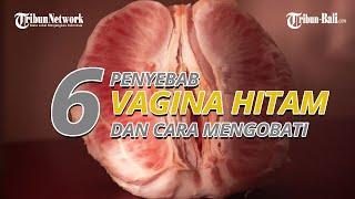 6 Penyebab Vagina Hitam Termasuk Akibat Gesekan