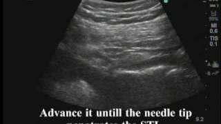 Ultrasound-guided pudendal nerve block