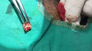 Sebacea cyst