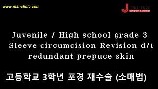 JuvenileHigh school grade 3 Sleeve circumcision Revision dt redundant prepuce skin-고등학교3학년 포경 재수술