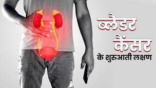 Early Signs And Symptoms of Bladder Cancer in Hindi  Bladder cancer ke lakshan and its treatment