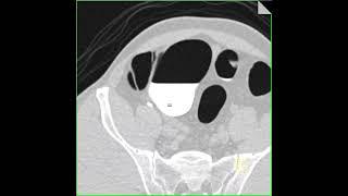 Virtual colonoscopy with retained fluid in right colon