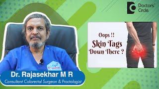 ANAL SKIN TAGS -Irritating down there? CauseSymptom & Treatment-Dr.Rajasekhar M R  Doctors Circle