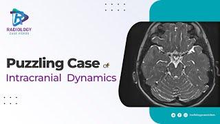 A Puzzling Case of Intracranial Dynamics