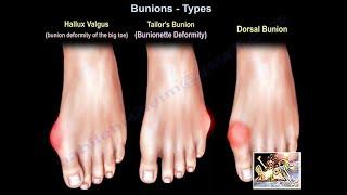 Bunions Types - Everything You Need To Know - Dr. Nabil Ebraheim