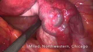 Surgical treatment of blocked fallopian tubes