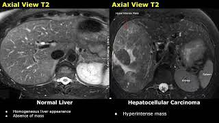 Liver MRI Normal Vs Hepatocellular Carcinoma HCC Images  T1 T2 DWI ADC & Contrast Sequences