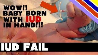 IUD Fail - Baby born with IUD in hand