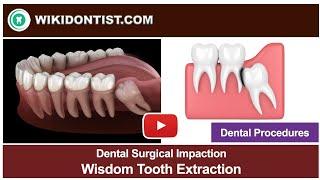 Wisdom Tooth Extraction - Dental Procedures  A Video by Dr. Thomas Nechupadam