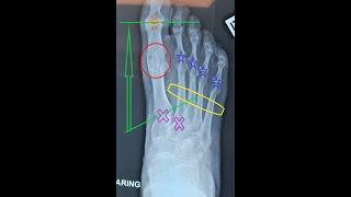 An Alternative To Fusion Of The Big Toe Joint The Decompression Osteotomy