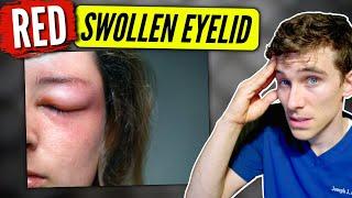 Swollen Eyelid causes & solutions - Eye Doctor Explains