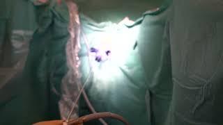 Asvide Pneumovaginal endoscopic surgery a new approach to vaginal septum resection…