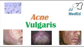 Acne Vulgaris  Causes Pathogenesis Influencing Factors Diagnosis Treatment and Complications