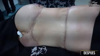 CIRUGÍA POST MANGA GASTRICA Torsoplastia + Tummy Tuck Circular