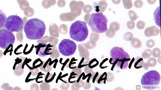 Acute Promyelocytic Leukemia APL microgranular vs classic cottage loaf cells. Hematology