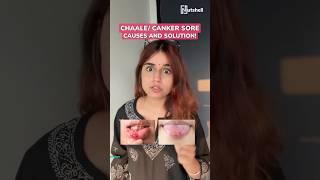 How to cure canker sore or chaale?  Nutshell shorts #158  #shorts