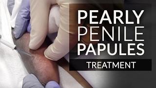 Get Rid of Pearly Penile Papules PPP  Fordyce Spot Removal Treatment by Dr. Jason Emer MD