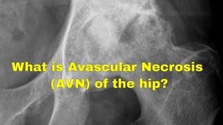 What causes avascular necrosis of the hip AVN?