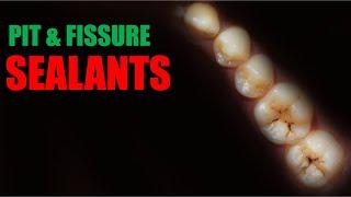 Pit and fissure sealants