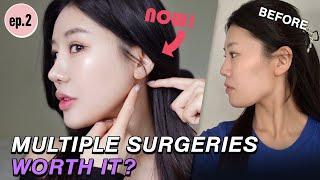 SUBEp.2 New Update on a 6-month Post Surgery of Multiple Procedures here at Nana Plastic Surgery