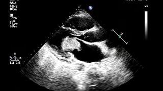 Cardiac Myxoma Revealed by Transthoracic Echocardiography