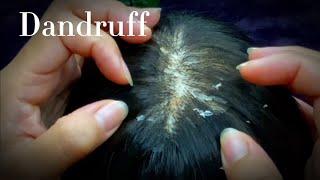 ASMR Super Triggers Dandruff Removal  No Talking 