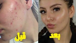 بهترین روش ها برای از بین بردن جای جوش و لکه ها روی صورت برای همیشه