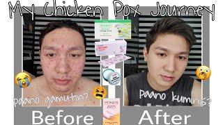 How to get clear skin + how to get rid of CHICKEN POX scars ft. PONDS SKIN PERFECTING CREAM DETOX