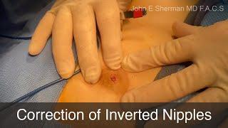 Correction of Inverted Nipple - Dr. John E Sherman