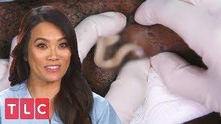 Dr. Lee Extracts Painful Cysts  Dr. Pimple Popper