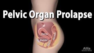 Pelvic Organ Prolapse Animation
