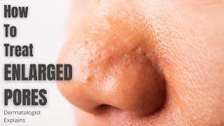 Enlarged Pores  How to effectively treat