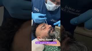 Non surgical rhinoplasty  Instant nose job results in just 15 mins