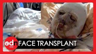 Worlds First Face and Hand Transplant Surgery Hailed a Success