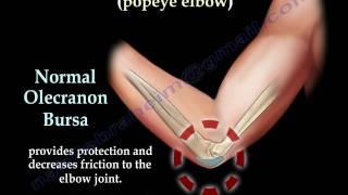 Bursitis Elbow  Olecranon  Popeye Elbow - Everything You Need To Know - Dr. Nabil Ebraheim