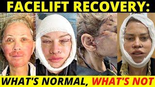 Facelift recovery day by day Whats normal whats not