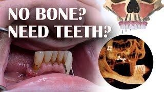 Lack of bone mass? Zygomatic Dental Implants Specialist is ready to help you