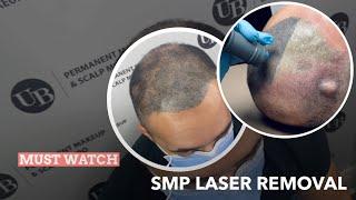 Learn how to remove botched Scalp Micropigmentation ️Behind the scenes️