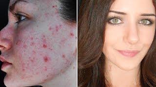 How To Cover Acne & Scars IF You Want To  Easy Makeup Transformation Routine