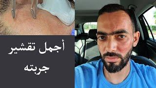 تقشير بارد - أجمل نوع جربته cool peel