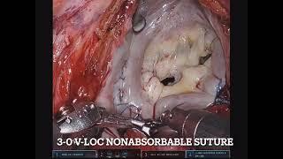 Asvide Port-only totally endoscopic approach to robotic mitral valve repair.